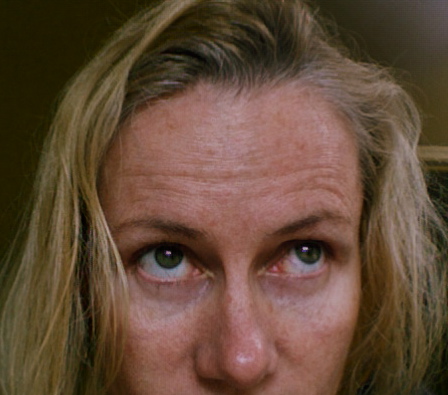 Forehead lines (lower only) 2011